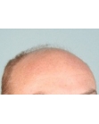 Before Hair Transplant&nbsp;2 Sessions (Areas)